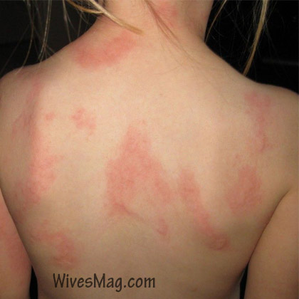 Symptoms, Causes, Home Remedies & Treatments For Urticaria Or Hives