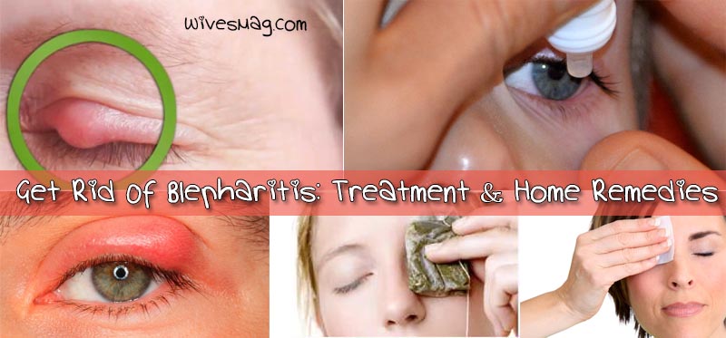 How To Get Rid Of Blepharitis (an Eyelid Swelling Disease)